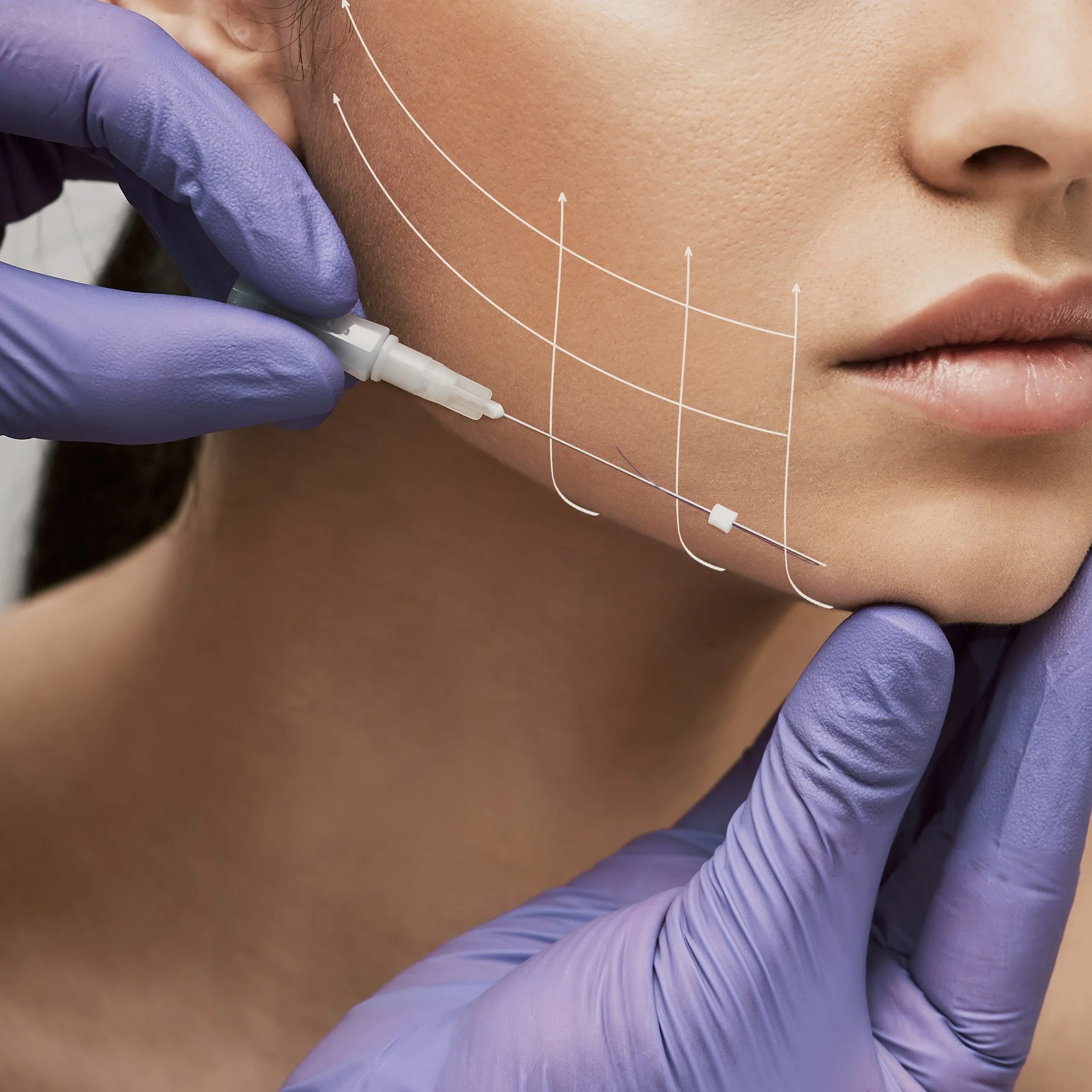 لیفت صورت بدون جراحی در ۲۰۲۶؛ کدام روش واقعاً ماندگارتر است؟