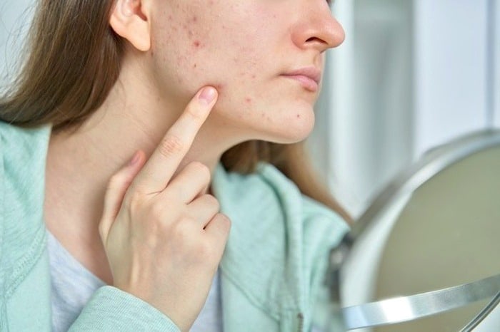 تغییرات هورمونی چه بلایی سر پوست می‌آورند؟